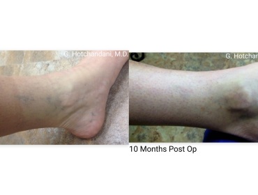 vascular_conditions_before_and_after-8