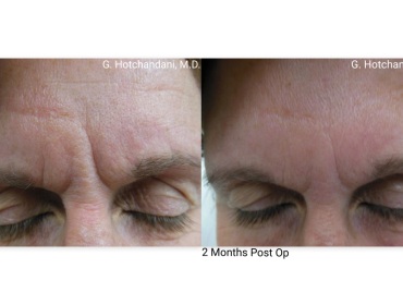 botox_and_filler_before_and_after-1