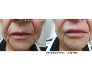 botox_and_filler_before_and_after-10