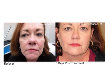 botox_and_filler_before_and_after-11