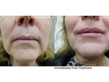 botox_and_filler_before_and_after-12