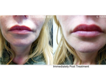 botox_and_filler_before_and_after-15