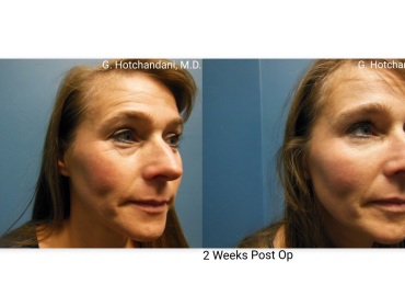 botox_and_filler_before_and_after-16
