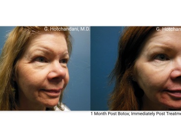 botox_and_filler_before_and_after-17