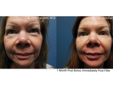 botox_and_filler_before_and_after-19
