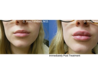 botox_and_filler_before_and_after-2
