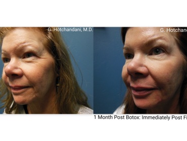 botox_and_filler_before_and_after-20