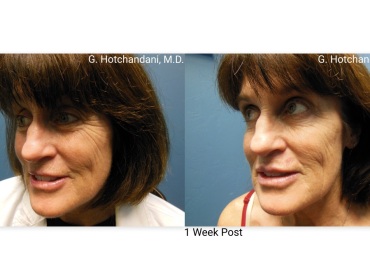 botox_and_filler_before_and_after-23
