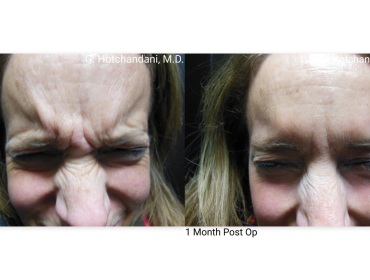 botox_and_filler_before_and_after-25