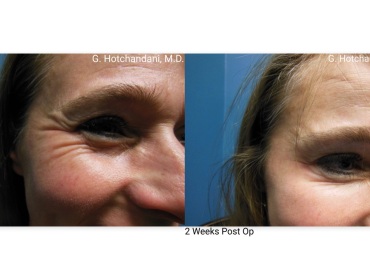 botox_and_filler_before_and_after-26
