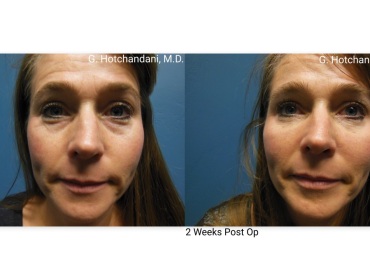 botox_and_filler_before_and_after-27