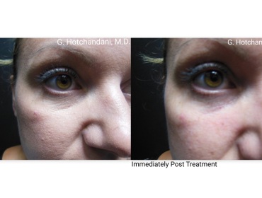 botox_and_filler_before_and_after-28