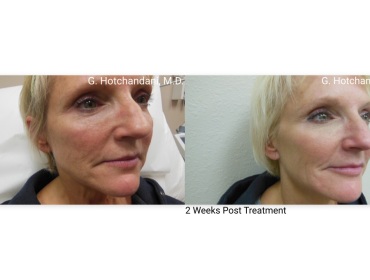botox_and_filler_before_and_after-29
