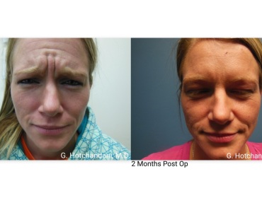 botox_and_filler_before_and_after-3