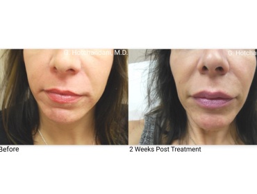 botox_and_filler_before_and_after-4
