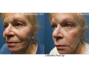 botox_and_filler_before_and_after-5