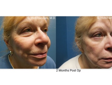 botox_and_filler_before_and_after-6
