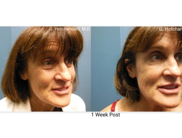 botox_and_filler_before_and_after-7