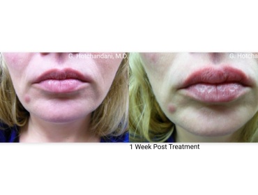 botox_and_filler_before_and_after-8