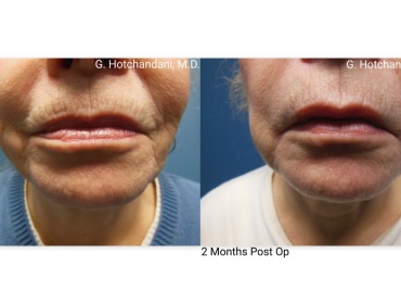 botox_and_filler_before_and_after-9