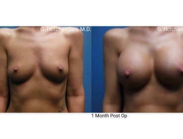 breast_surgery_before_and_after-10