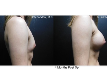 breast_surgery_before_and_after-13