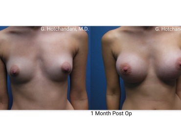 breast_surgery_before_and_after-15