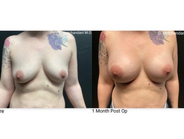 breast_surgery_before_and_after-16