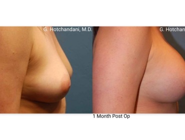 breast_surgery_before_and_after-17