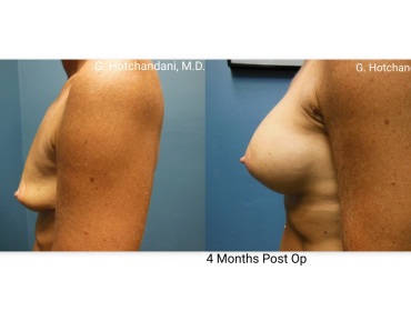 breast_surgery_before_and_after-18