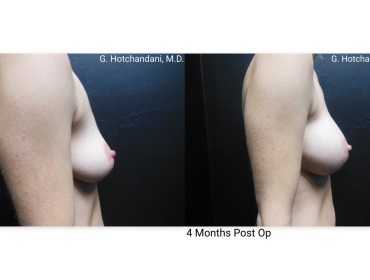 breast_surgery_before_and_after-19