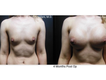 breast_surgery_before_and_after-2