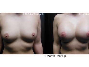 breast_surgery_before_and_after-20