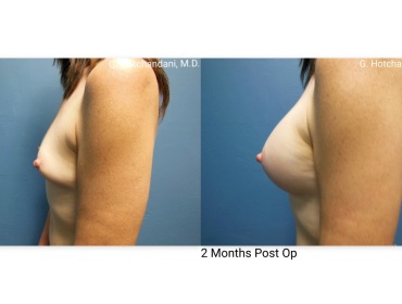 breast_surgery_before_and_after-21