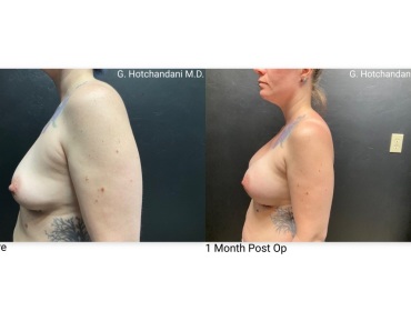 breast_surgery_before_and_after-24