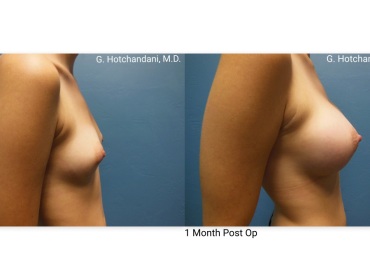 breast_surgery_before_and_after-26