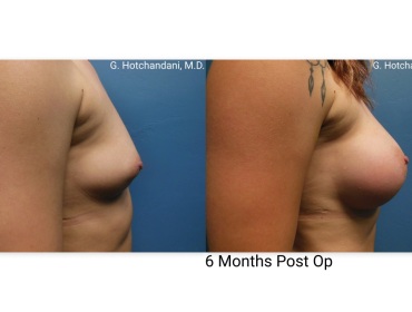 breast_surgery_before_and_after-32