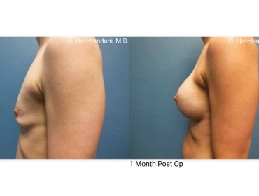 breast_surgery_before_and_after-33