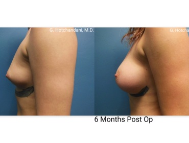 breast_surgery_before_and_after-39