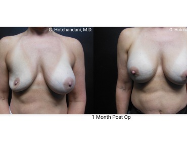breast_surgery_before_and_after-40