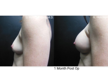 breast_surgery_before_and_after-41