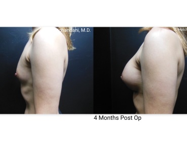 breast_surgery_before_and_after-42