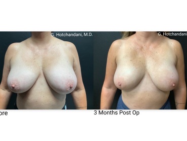 breast_surgery_before_and_after-43