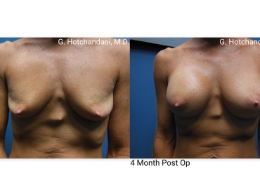 breast_surgery_before_and_after-7