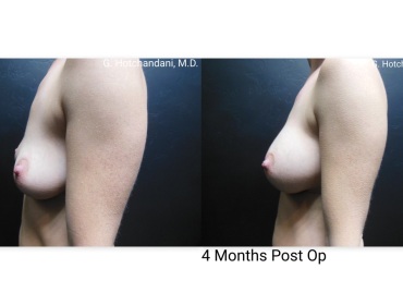 breast_surgery_before_and_after-8
