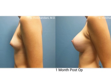 breast_surgery_before_and_after-9