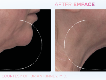 emface_before_and_after-3