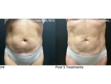 emSculpt_neo_before_and_after-5