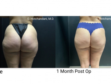 BS-before-after-renuplasty