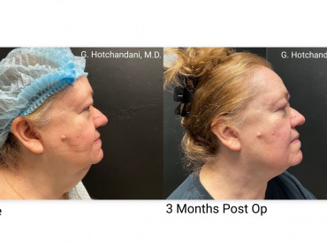 HO-before-after-renuplasty-1